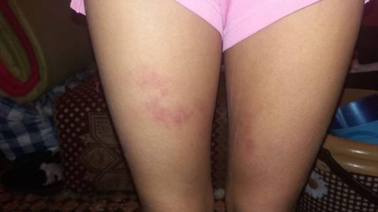 صورة للفتاة القاصر ضحية التعذيب من طرف مشغلها

