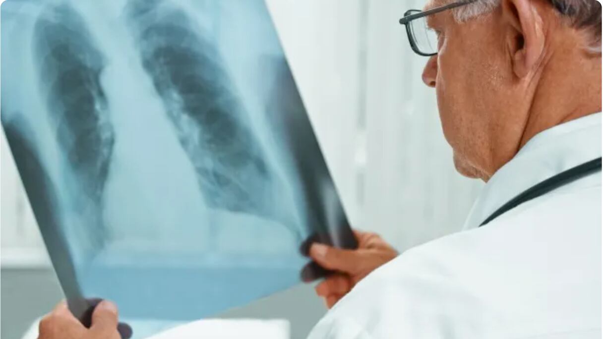 الإلتهام الرئوي الحاد "صورة تعبيرية"