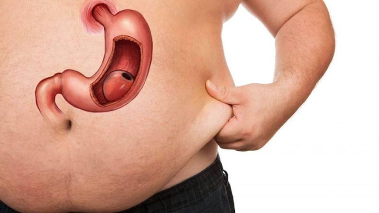 جراحة تكميم المعدة