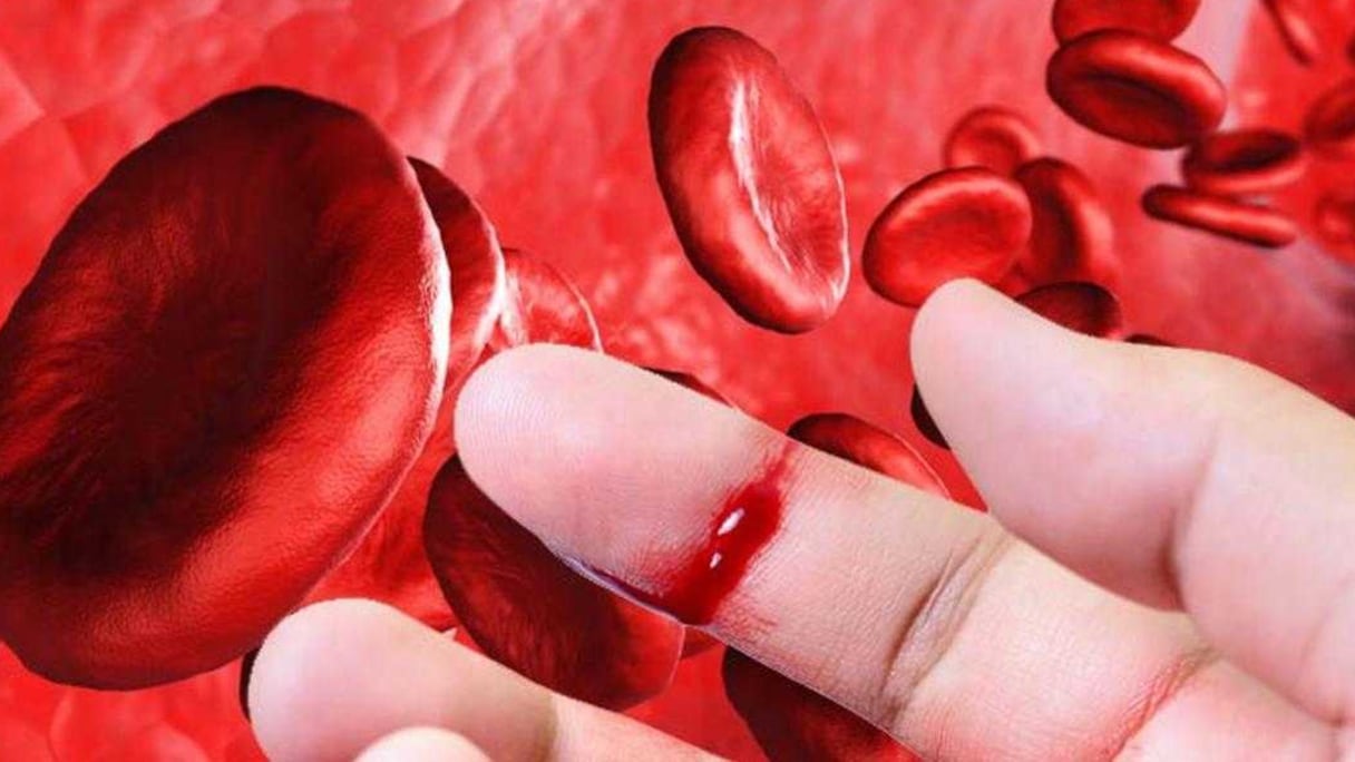 الهيموفيليا