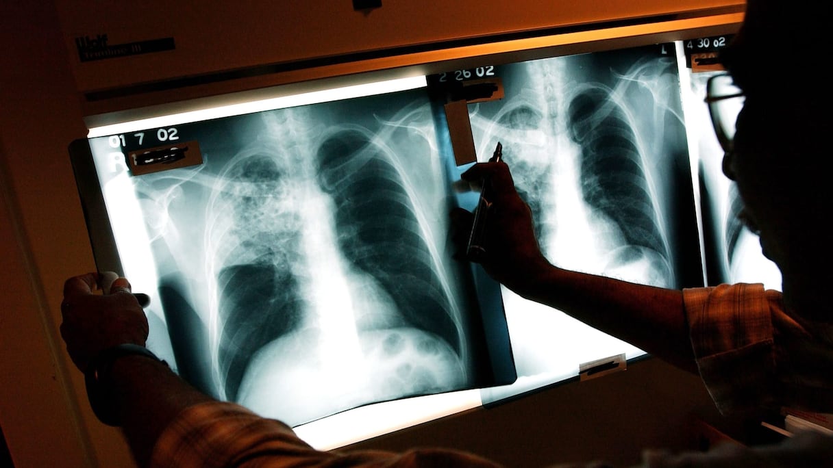 داء السل "صورة تعبيرية"
