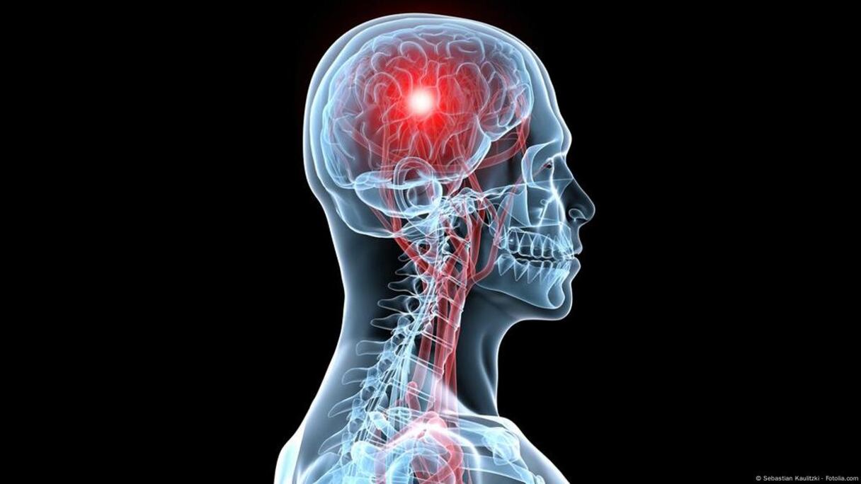 السكتة الدماغية "صورة تعبيرية"