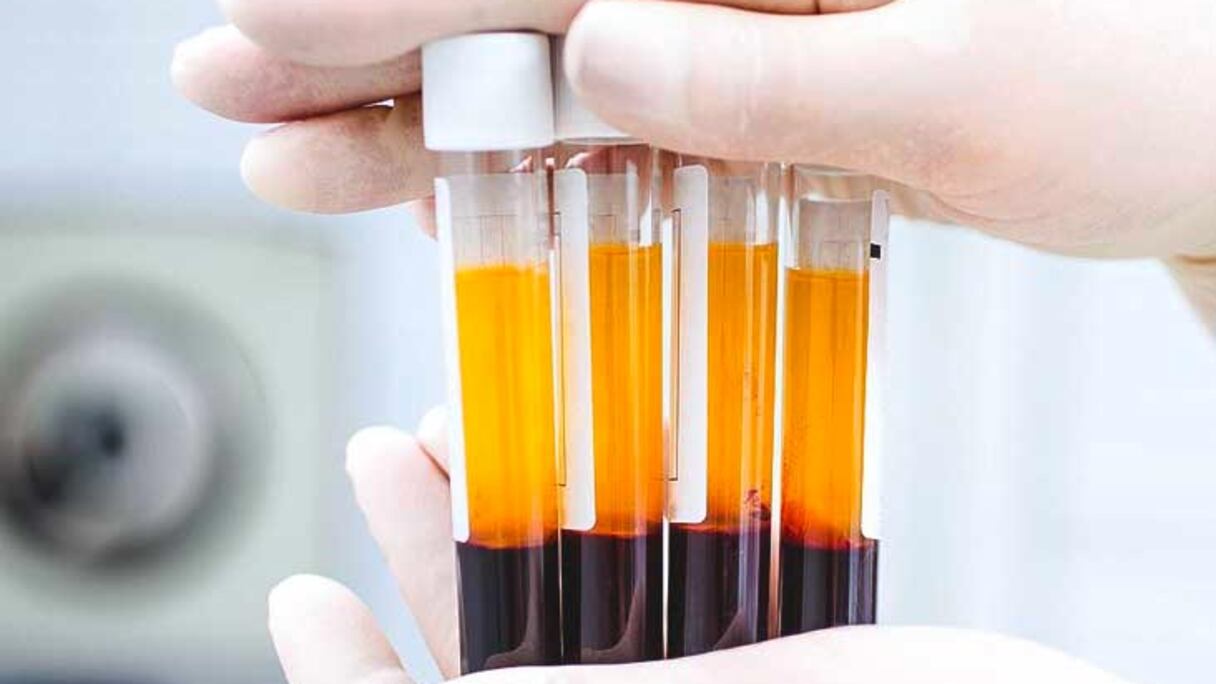 تقنية "وجه مصاص الدماء" لتجديد بشرة الوجه