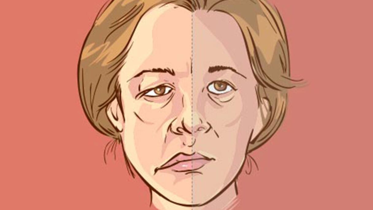 شلل الوجه النصفي