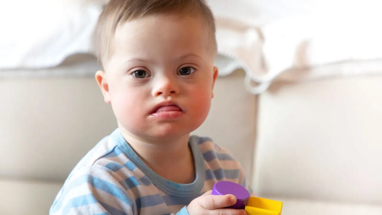 طفل مصاب بمتلازمة داون