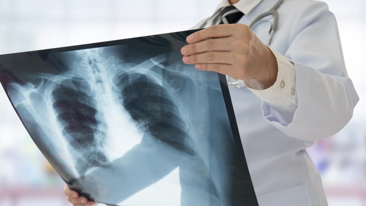 صورة تعبيرية-داء السل يسكن صدور أزيد من 30 ألف مغربي