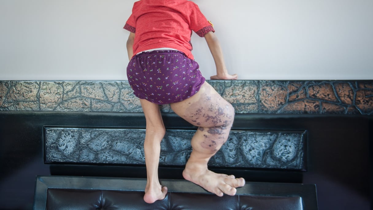 طفل مصاب بتضخم النهايات، أحد أبرز الأمراض النادرة